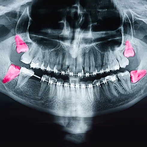 Zahnarztpraxis RHEIN WEISS Mainz Oralchirurgie Röntgenbild Weisheitszähne
